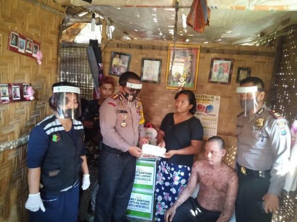  Kapolres Langkat Serahkan Bantuan Kapolda Sumut Untuk Nano Penderita Sindrom Steven Jhonson